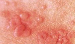 皮炎子吃瓜,揭秘娱乐圈的甜蜜瓜田